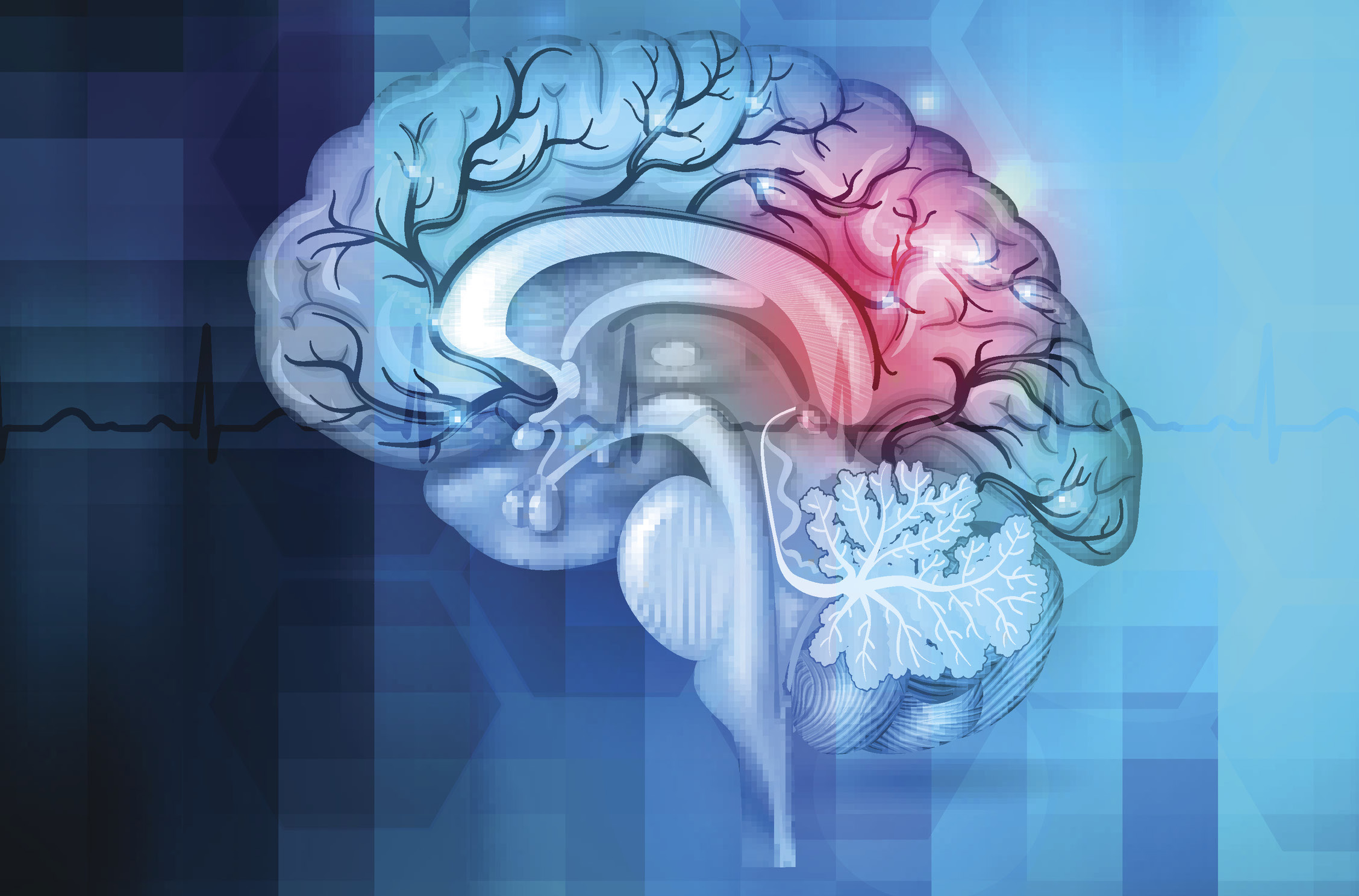 Brain Attack & Cerebrovascular Disease UPDATE 2019 | Neurology